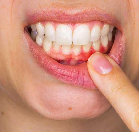 Diş Eti Hastalıkları